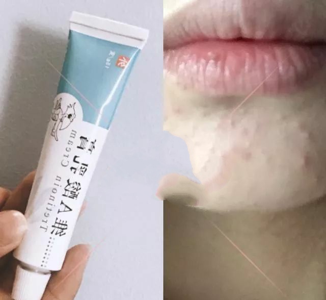 痘痘肌必备的消痘神器,秋冬战痘神器推荐