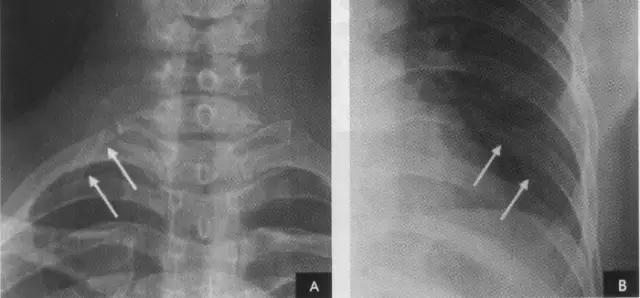 x线胸部解剖,胸部x线解读视频