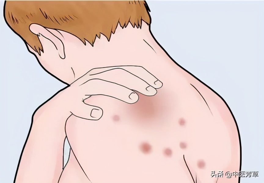 中医辨证麻疹,荨麻疹类型及辨证论治