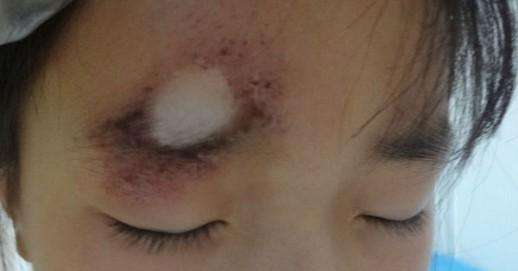 什么原因会导致婴儿得白癜风,孩子出生就有白癜风原因