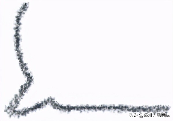 每天掉睫毛需要警惕吗,睫毛掉光会怎么样