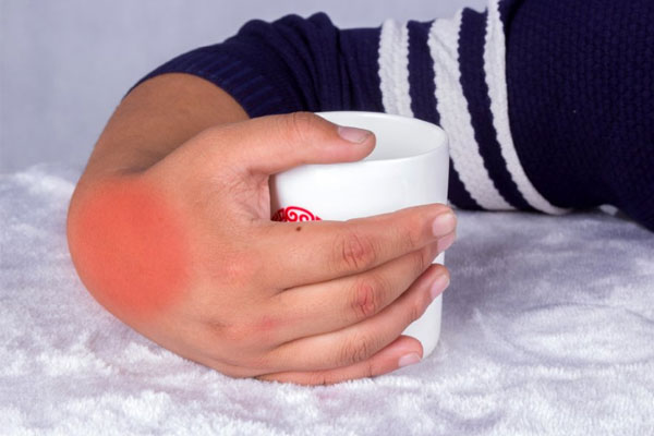 什么叫做痛风痛风有什么表现,痛风怎么得的痛风前兆脚疼