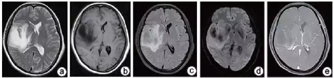 脱髓鞘病变是什么病怎么读,脱髓鞘病变的特征
