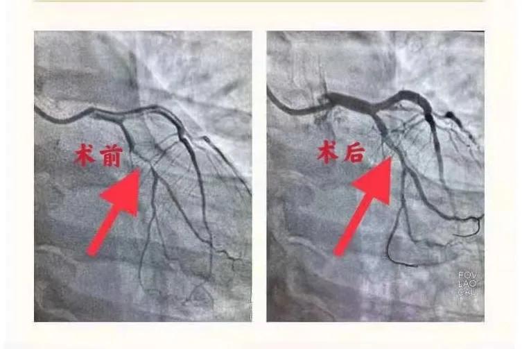 外科医生治疗血管狭窄,颅内动脉狭窄介入治疗专家