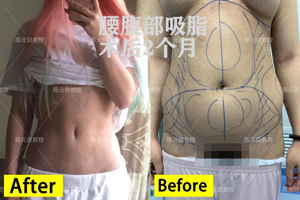 去做吸脂手术都咋想的,想抽脂需要了解的事项