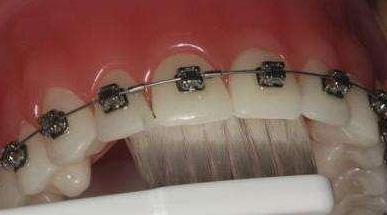 牙齿有黑三角会不会越来越严重,牙齿开始出现黑三角怎么办