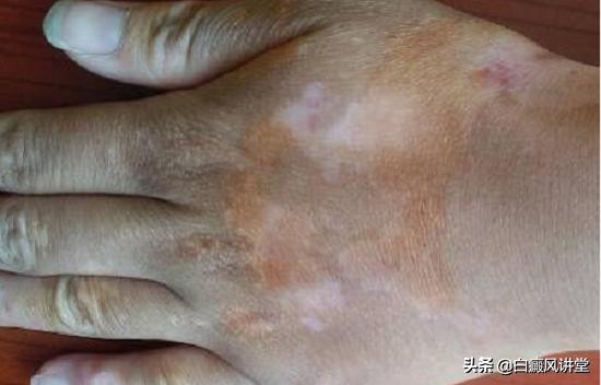 白癜风患处能抹防晒霜吗,白癜风的患处抹皮炎平吗