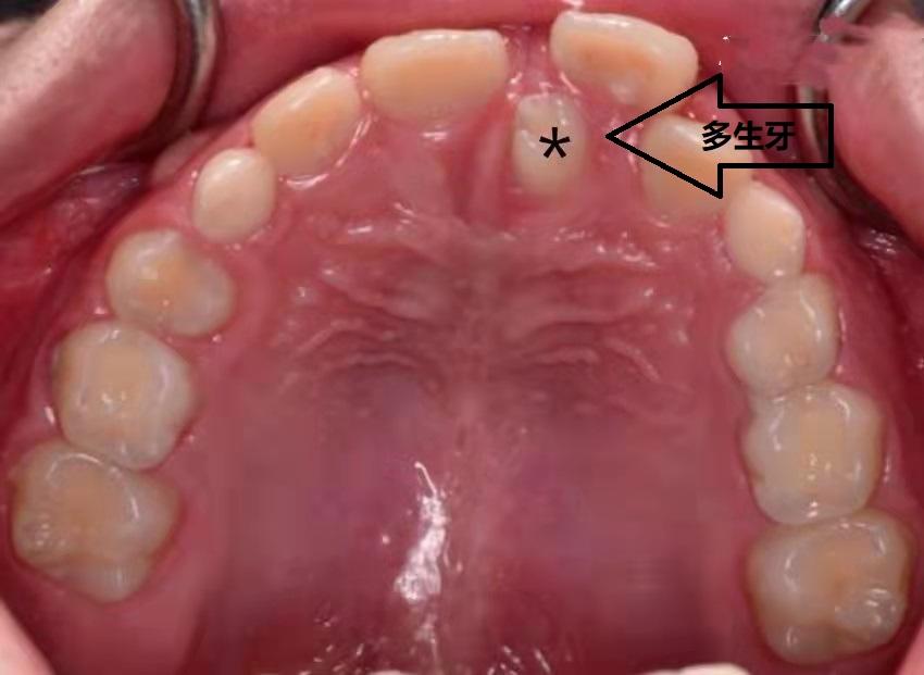 门牙中间为什么有缝隙,门牙中间有缝咋回事