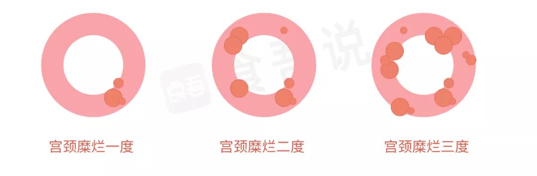 宫颈糜烂且hpv感染会得宫颈癌吗,宫颈糜烂1度2度用做宫颈癌筛查吗