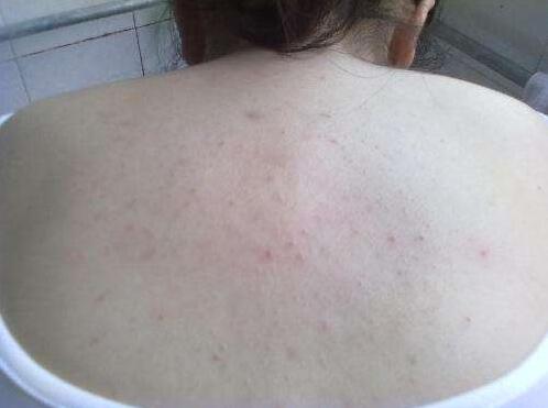 怎么可以让后背痘痘不再蔓延了,后背痘痘怎么治疗最有效