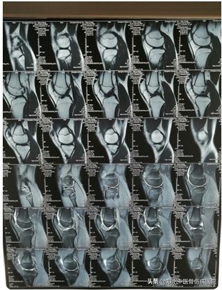 手抬不起来针灸疗法,坐下站不起来针灸穴位