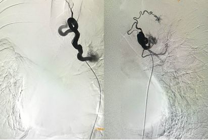 举例科普|介入能治疗哪些疾病?
