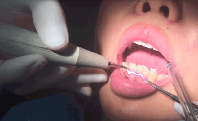 祛痘、脱毛、洗牙？点开这篇文章，离女神更近一步