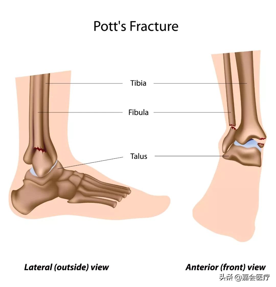 脚踝损伤怎么快速消肿,脚踝损伤怎样有利于恢复