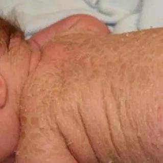 鱼鳞病分类及症状,鱼鳞病怎么区分类型