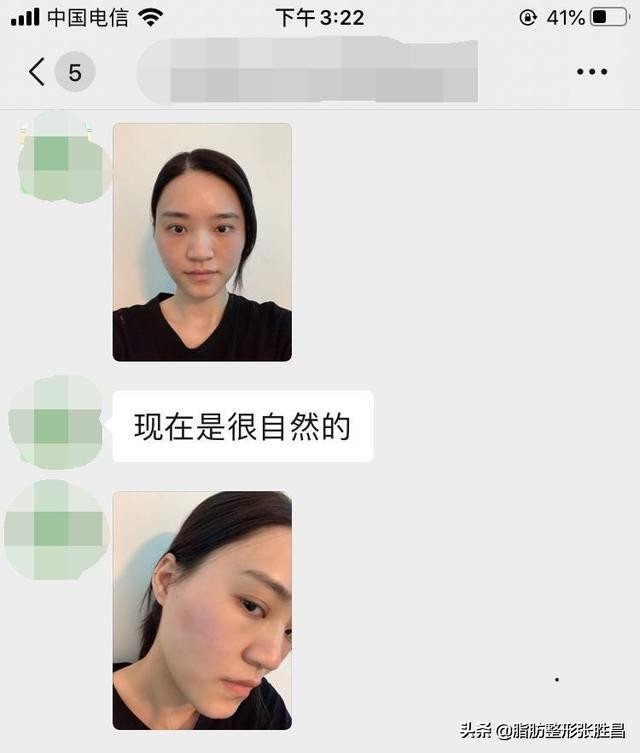 自体脂肪胶填充太阳穴泪沟法令纹,自体脂肪太阳穴填得太饱满了