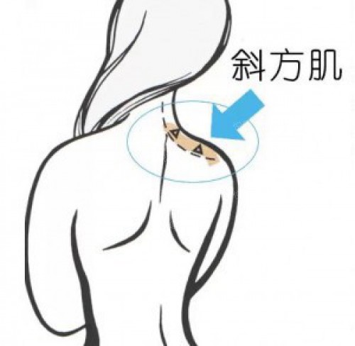 明星溜肩矫正前后,缩肩的危害