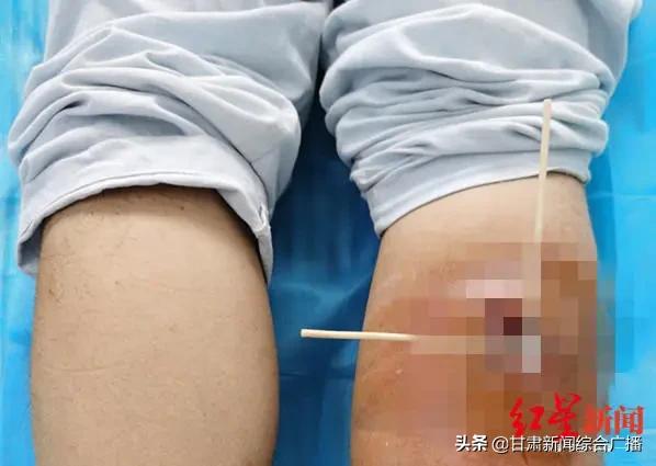 男子被虫子咬后腿肿了,小伙子被蚊虫咬了得了病