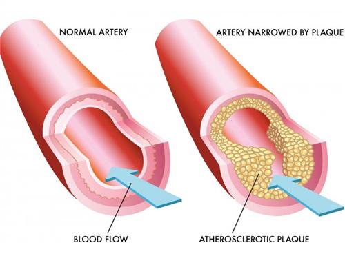 血栓辟谣,经常运动血栓