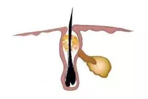 小学学生鼻子长黑头如何快速去除,怎样去除鼻子上的螨虫和黑头