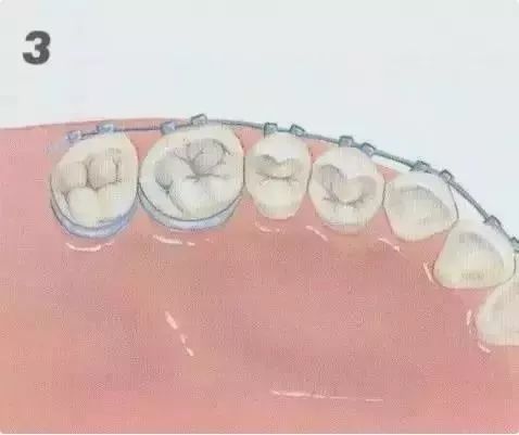 透明牙套和钢牙哪个好,老牙选哪种牙套比较合适价位低