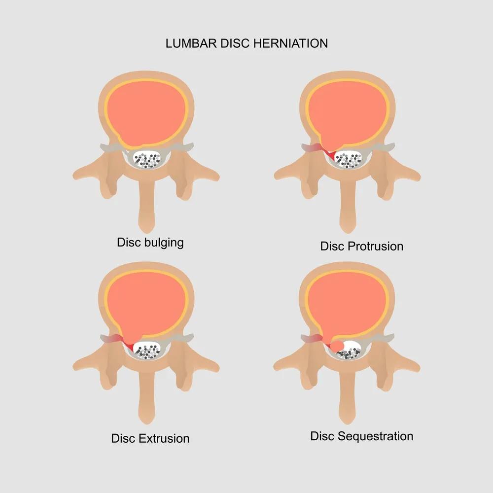 椎间盘突出按摩好还是牵引好,腰椎5骶1椎间盘突出可以按摩吗