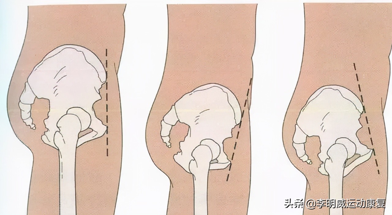 骨盆不正的危害动画视频,骨盆不正危害图片