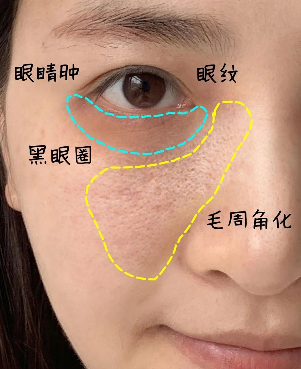 平价祛痘好物测评:理肤泉K乳见效快,红霉素软膏去闭口超赞