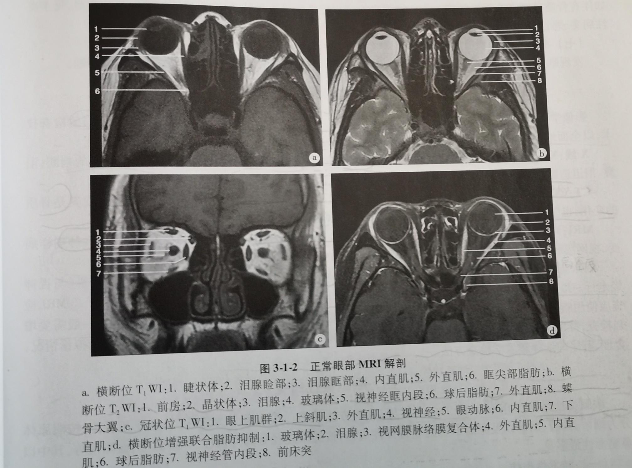 眼眶病变的常用检查方法,眼眶神经鞘瘤影像诊断