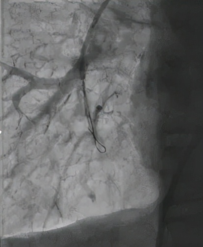 一个肠息肉切除干净后还会复发吗,肠息肉esd手术可以切除多大息肉