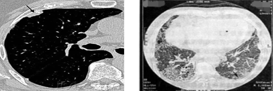 56岁男性发现双肺数百个结节,肺部肿块伴胸腔积液