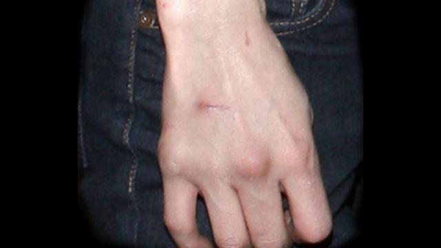 伤口鼓起一个小包,伤口长了一个小小的东西怎么办