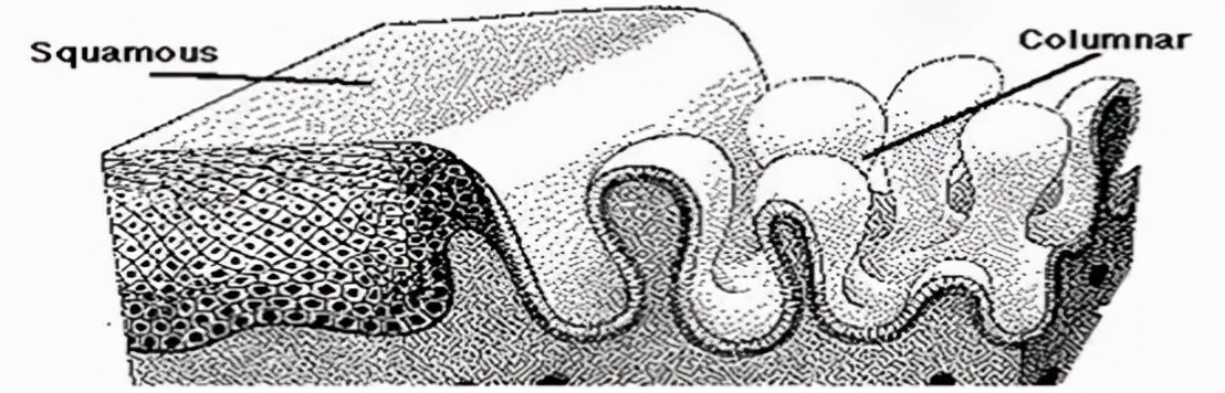 宫颈糜烂出血是很严重的病吗,女人宫颈糜烂可怕吗