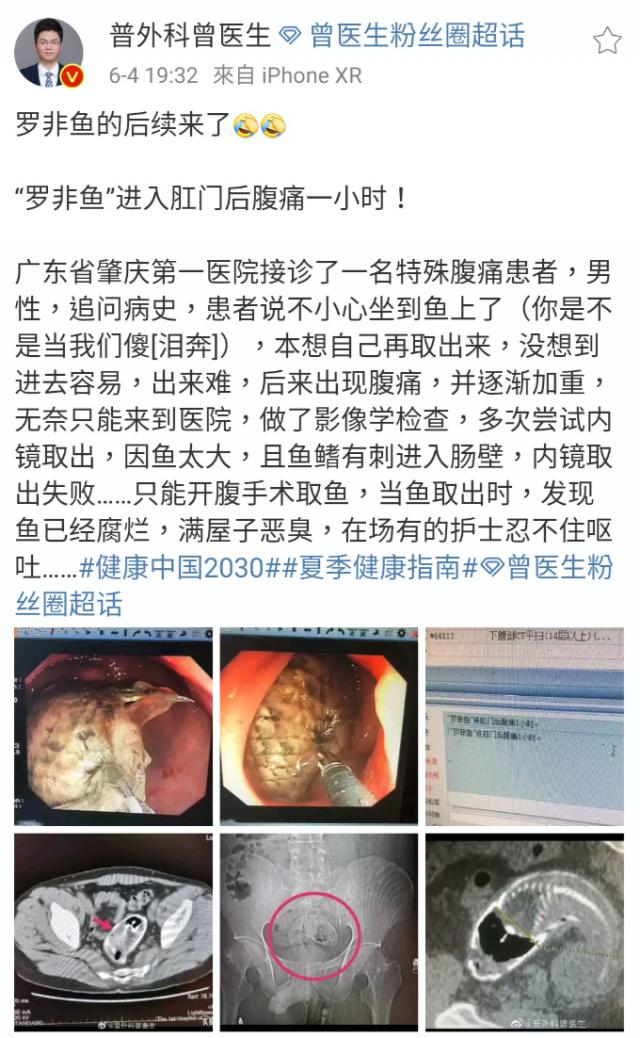 一条罗非鱼“游”进肛门？医生：直肠不直，进去容易出来难
