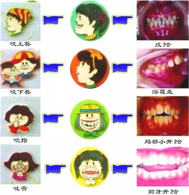 矫正牙齿是如何戴牙套的,矫正牙齿戴牙套需要注意事项