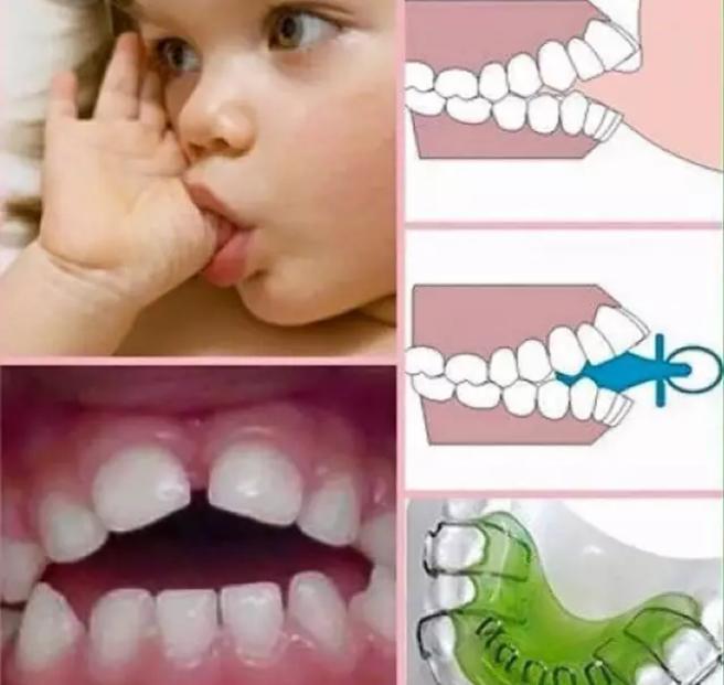 小孩儿嘬手指会导致什么,三个月宝宝一直嘬手指要不要干预