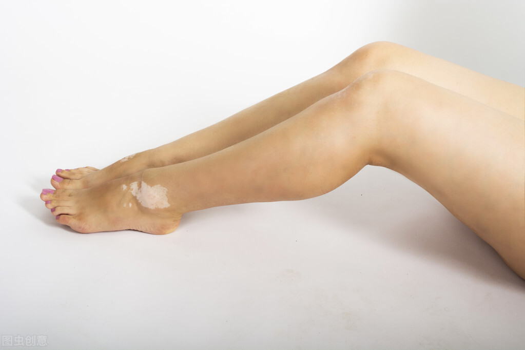 白癜风治疗省钱妙招,白癜风怎样治疗比较省钱又有效