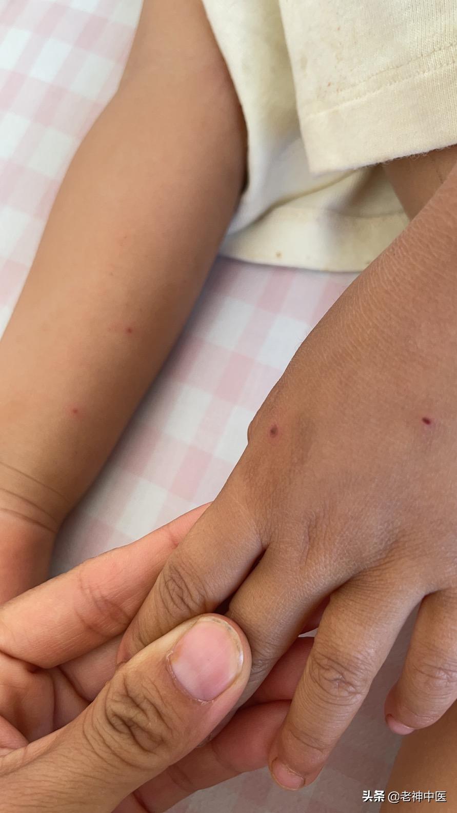 成人手足口病传染,儿童手足口病怎么传染的