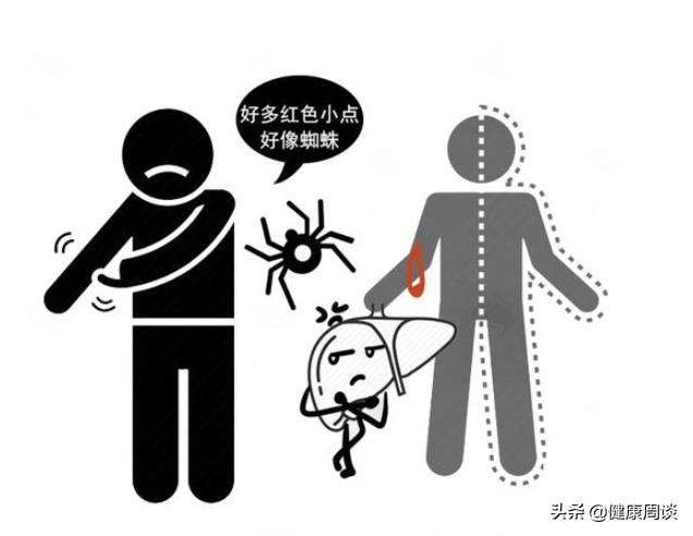 红色的蜘蛛痣咋回事,肝病蜘蛛痣出现是早期还是晚期