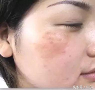 遗传斑祛斑最有效方法,斑怎么祛除最快最有效