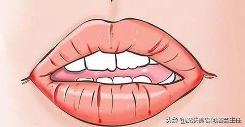 唇部干裂护理方法,嘴唇干裂起皮护唇推荐