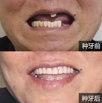 种植牙的一般使用寿命是多久,种植牙使用寿命多长需要更换吗