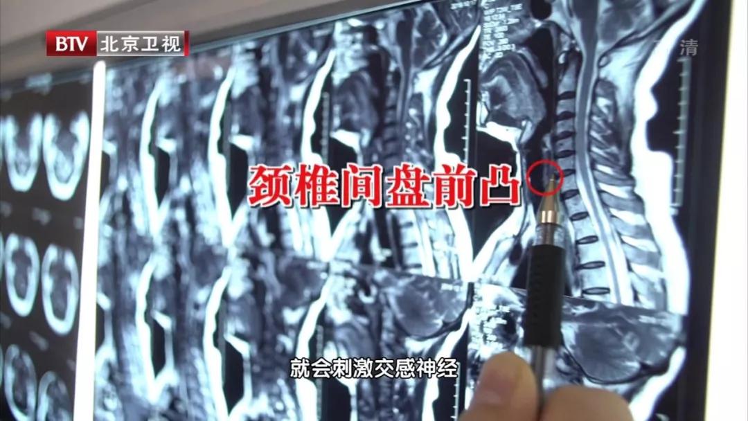 颈椎病突然引起胸口疼,颈椎病突然发作心悸头晕血压高