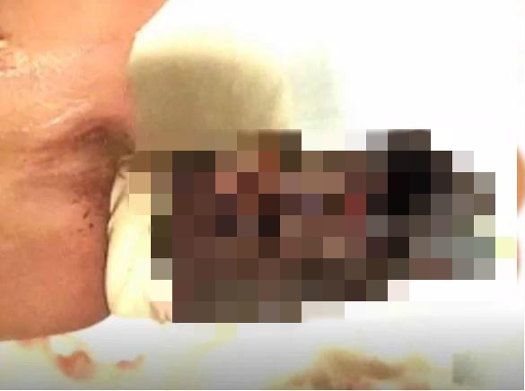 护士忘记取下止血带,护士忘记取止血带三个小时