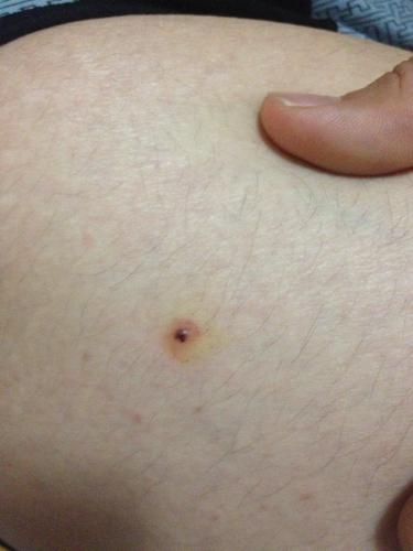 身上出现小黑点不疼也不痒,身上出现了黑点怎么回事