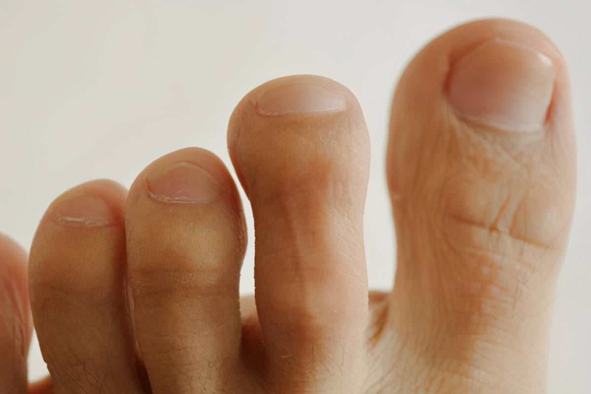 脚趾甲总往肉里长，怎么办？如何缓解甲沟炎？