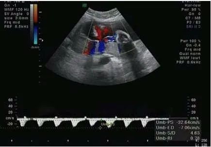脐血流偏高有什么影响,脐血流值偏高会影响胎心率吗