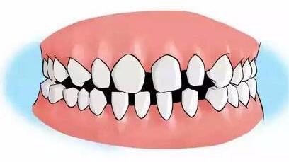 牙周太差怎么矫正,牙周不好怎么矫正牙齿