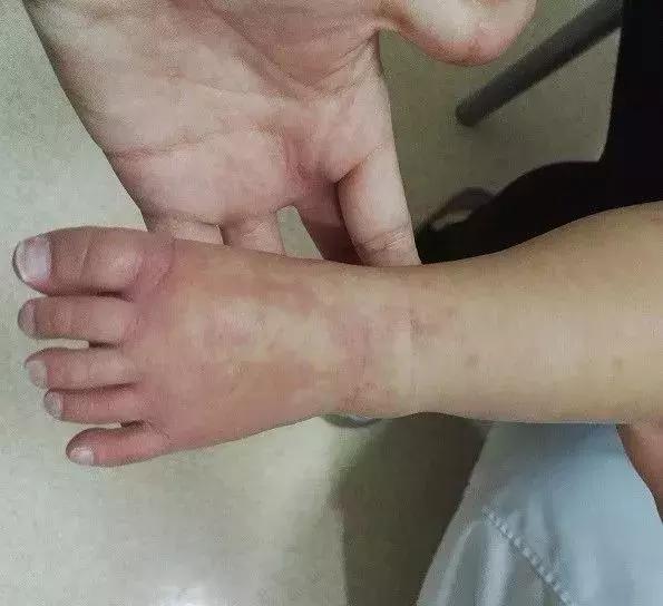 孩子扁桃体发炎连续三天高烧不退,老人连续几天高烧不退怀疑什么病