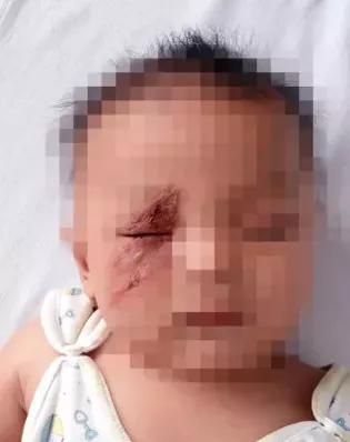 孩子被毒虫咬的伤疤怎么去掉,小孩被毒虫咬了用什么方法解决